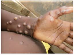 Monkey pox eUganda